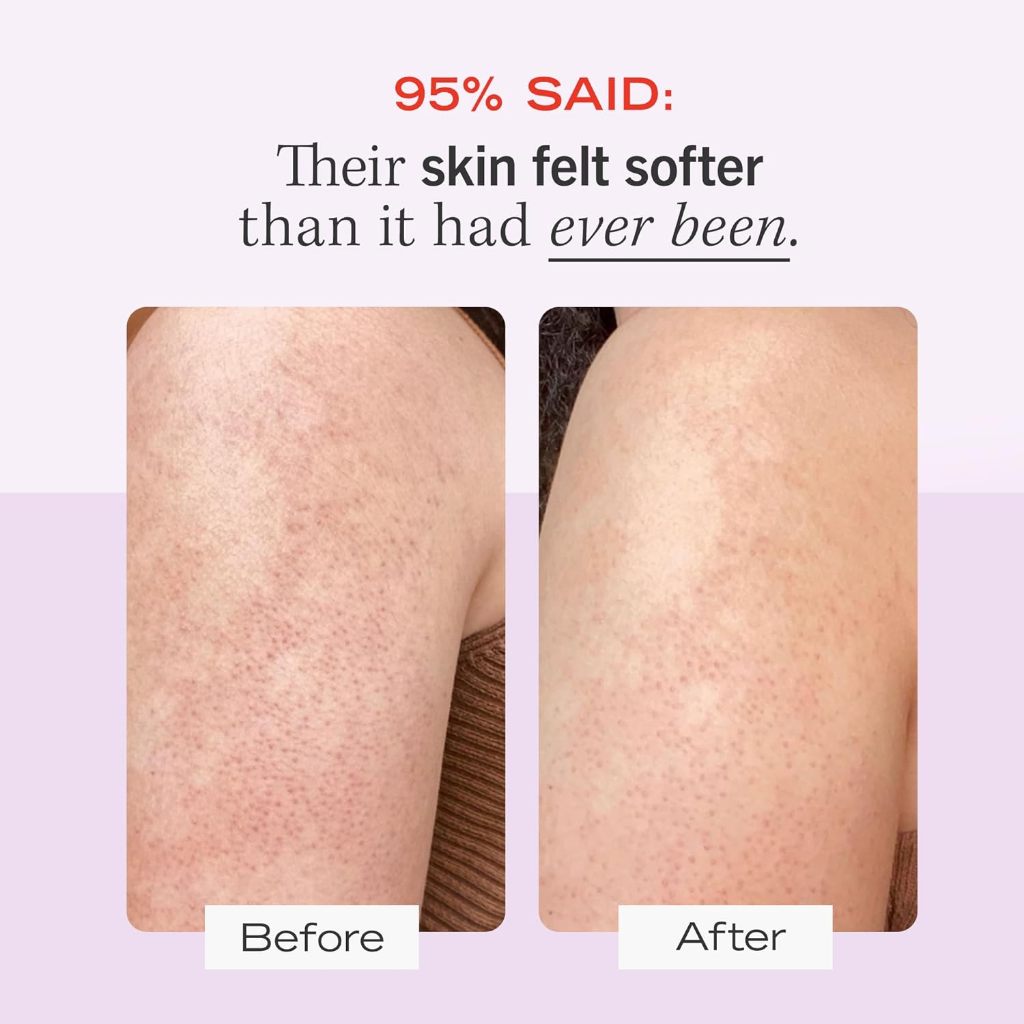 First Aid Beauty KP Bump Eraser Body Scrub 226g | Exfoliates Roughness + Scaly Areas