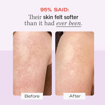 First Aid Beauty KP Bump Eraser Body Scrub 226g | Exfoliates Roughness + Scaly Areas